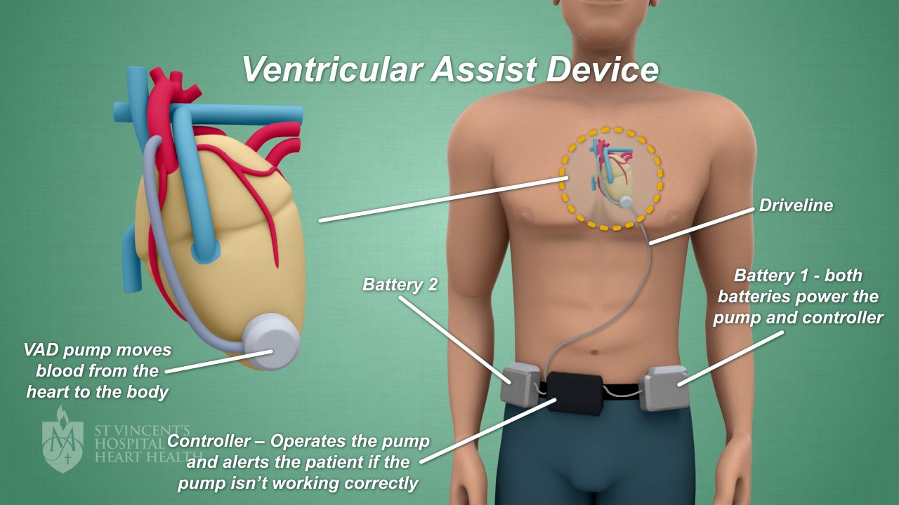 Left Ventricular Assist Devices (LVAD) for Heart Conditions