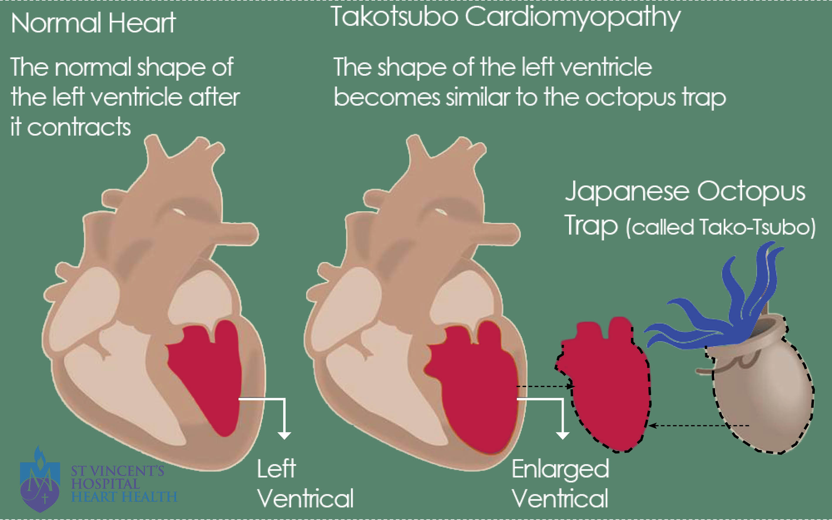 Takotsubo cardiomyopathy (broken heart syndrome): what is it