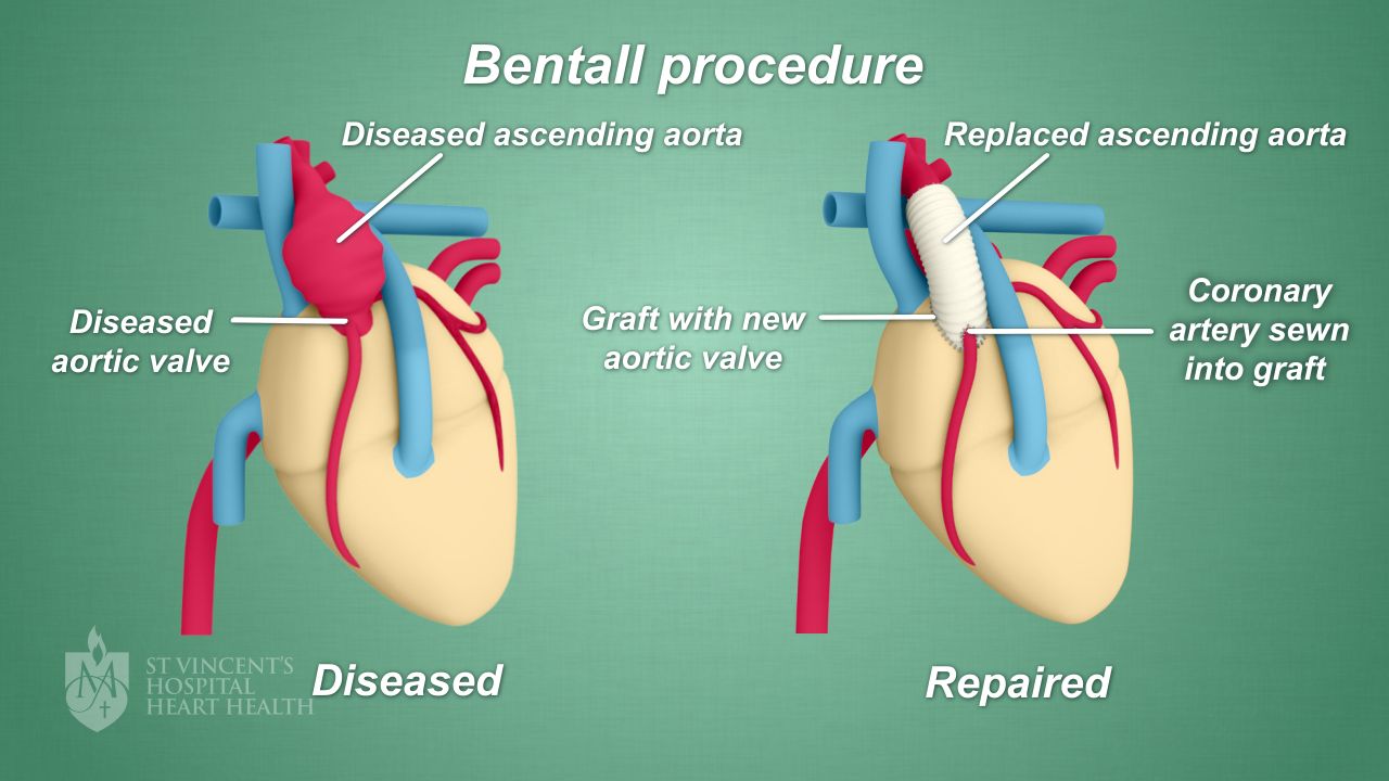 Bentall Procedure St Vincents Heart Health
