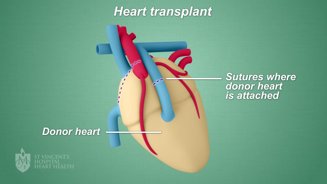 09_HeartTransplant